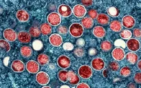 Dạng đậu mùa khỉ "khủng khiếp" ảnh hưởng đến người nhiễm HIV giai đoạn cuối