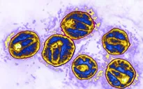Bệnh nhân thứ ba khỏi hoàn toàn virus HIV nhờ cấy ghép tế bào gốc