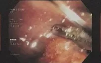 Đi khám vì đột ngột ho ra máu, nam thanh niên phát hiện u ác tính hiếm gặp
