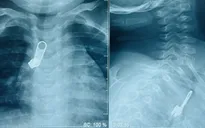 Lấy móc khóa kéo trong phế quản bé trai 15 tháng tuổi