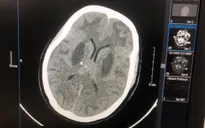 Bệnh viện Bạch Mai thông tin về vụ nhiễm độc methanol ở Bắc Ninh