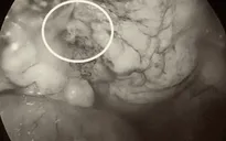 Trượt chân ngã trong nhà tắm, 3 ngày sau nhập viện cấp cứu vì vỡ bàng quang