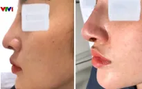 Nâng mũi, cô gái ở Vĩnh Long bị nhiễm trùng, lộ sống mũi