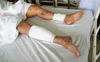 Tự học chế pháo nổ trên mạng, 1 nam sinh tử vong, 1 bị thương nặng