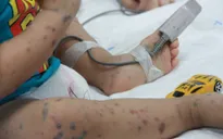 Hà Nội: Xuất hiện ổ dịch tay chân miệng tại trường mầm non