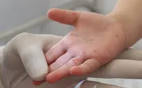 Thêm 1 ca tử vong do tay chân miệng tại Bà Rịa - Vũng Tàu