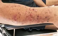 Hiếm gặp: Bệnh nhân bị rối loạn tâm thần sau đột quỵ não