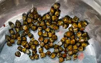 113 viên sỏi lấp đầy túi mật bệnh nhân