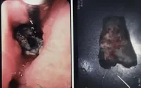 Nhập viện vì uống thuốc quên bóc vỏ, hóc xương