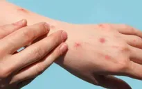 Bến Tre: Phát hiện ca mắc bệnh đậu mùa khỉ đầu tiên