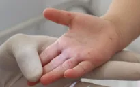 Đắk Lắk: Bệnh nhi 2 tuổi tử vong vì bệnh tay chân miệng