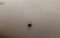 Ca bệnh sốt mò đầu tiên được ghi nhận tại khu vực phía Nam