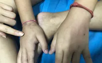 Điều trị thành công cho bé trai bị viêm mao mạch dị ứng nghiêm trọng