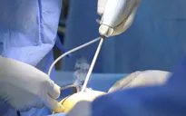 Dấu hiệu nhận biết co thắt bao xơ trong 6 tháng đầu nâng ngực