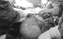 Đi khám vì đau bụng, người phụ nữ phát hiện khối u xơ nặng hơn 5kg