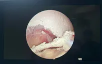 Biến dạng, mất chức năng vận động của khớp do mắc gout nặng