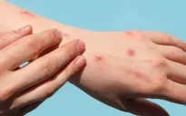 TP. Hồ Chí Minh ghi nhận 74 ca đậu mùa khỉ, 73% dương tính với HIV