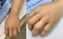 Truyền 6 lọ huyết thanh kịp thời cứu bệnh nhân bị rắn độc cắn
