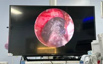 Đau đầu âm ỉ suốt mấy tháng vì nấm xoang bướm