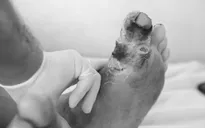 Phát hiện sớm đái tháo đường type 2 để tránh các biến chứng
