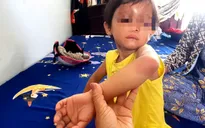 Vụ bé gái 4 tuổi ở Cà Mau bị đánh đập: Cha nuôi nhiều lần đánh con
