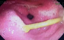 Đồng Nai: Nuốt cây tăm dài 4,5cm vào bụng, người phụ nữ phải nhập viện cấp cứu