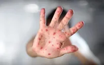 Khu vực phía Nam đã ghi nhận 62 ca bệnh đậu mùa khỉ