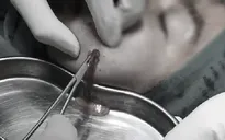 Thêm nhiều bệnh nhân bị biến chứng sau khi tiêm filler