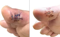 Nhiễm trùng da, áp xe trong cơ ở bệnh nhân đái tháo đường