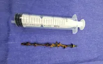 Cứu bệnh nhân bị tai nạn cành cây đâm xuyên mũi