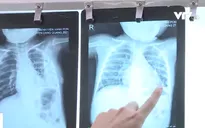 Cảnh báo nhiều trẻ viêm phổi do vi khuẩn tụ cầu