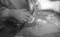 Kịp thời cứu bệnh nhân bị vỡ u đại tràng