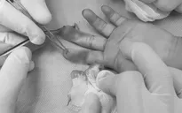 Nối gân ngón tay đứt rời cho bé gái bị tai nạn sinh hoạt