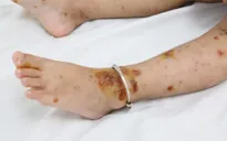 Cảnh giác bệnh thủy đậu hoại thư, đe dọa tính mạng