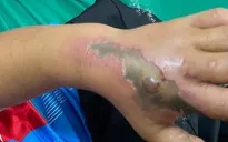 Bé trai bị hoại tử bàn tay nghi do rắn độc cắn