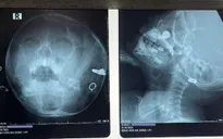 Bé 3 tuổi hoại tử 1 phần niêm mạc do pin cúc áo