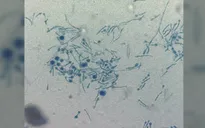 Phát hiện trường hợp đầu tiên nấm thực vật Chondrostereum purpureum lây nhiễm cho người