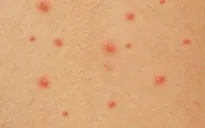 Số ca thủy đậu ở Hà Nội tăng