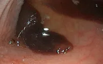 Cảnh báo áp xe gan do sán lá gan lớn