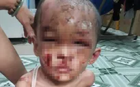Bé trai 1 tuổi người đầy vết thương, vết bỏng, nghi bị cha mẹ bạo hành