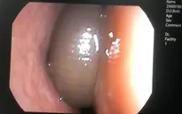 Chảy máu mũi suốt 3 tháng vì đỉa ký sinh