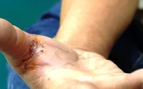 Người dân nên đi tiêm phòng vaccine dại ngay sau khi bị chó cắn, mèo cào