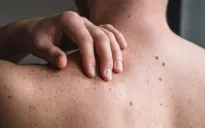 Vaccine ung thư thử nghiệm kết hợp liệu pháp miễn dịch có thể ngăn khối u ác tính phát triển