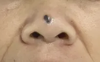 Cảnh báo ung thư da do chủ quan, không thăm khám, điều trị sớm