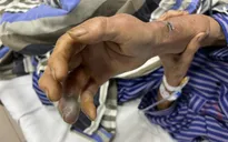 Nhiều người dân bị rắn độc cắn tại nhà