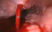 Cứu bệnh nhi 15 tuổi nôn ra máu do ổ loét dạ dày