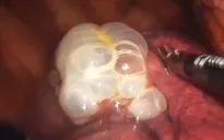 Phẫu thuật lồng ngực nội soi cắt kén khí phổi cứu bệnh nhân tràn khí màng phổi