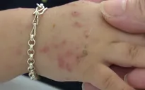 Bệnh tay chân miệng đang vào mùa - Cha mẹ lưu ý để bệnh không trở nặng