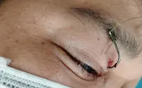 Lưỡi câu găm vào mắt khi đi câu cá