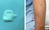 Suy tuyến thượng thận do tự điều trị bệnh bằng thuốc không rõ nguồn gốc tại nhà
